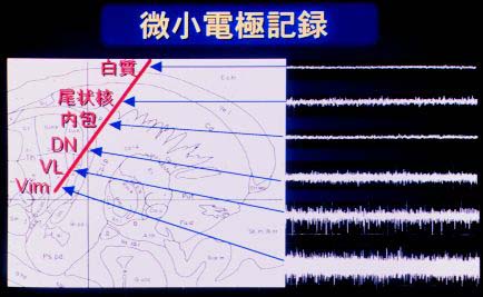 微小電極記録