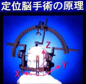 定位脳手術