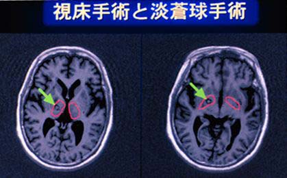 視床手術
